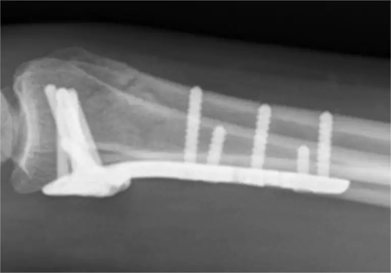 Fitantanana ny fractures distal radial complex (1)