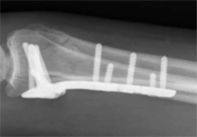 Ngatur Papatah Radial Distal Kompleks (1)