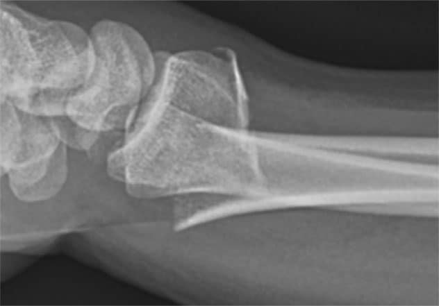 Kugadzirisa Yakaoma Distal Radial Fractures (2)