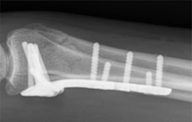 Gestion des fractures radiales distales complexes (3)