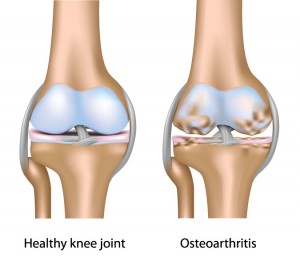 knee-joints-300x261